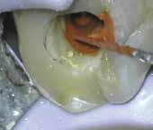 Soft or soluble pastes, pastes in the chamber or coronal one-third of the root that are removed