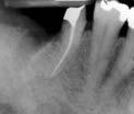 Clinical Photograph TREATMENT CONSIDERATIONS/PROGNOSIS > Remaining Coronal Tooth Structure