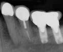 ENDODONTIC-PERIODONTIC LESIONS Case One Tooth