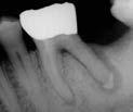 Recall Case Two Tooth #21 exhibiting a wide,