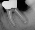 Recall Case Three Tooth #19 with an 8 mm