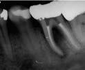 Moderate periodontal disease An isolated