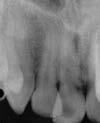 EXTERNAL RESORPTION Case One External resorptive defect on buccal aspect of tooth