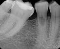 External Resorption Minimal loss of tooth structure Located cervically but above the