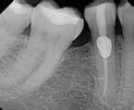 required The pulp may be vital or necrotic Structural integrity of the tooth or root