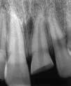 TOOTH FRACTURES Crown Fracture Tooth #8 exhibiting a complicated coronal fracture, root canal treatment and bonding of the coronal