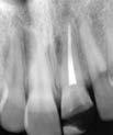 Clinical Photograph TREATMENT CONSIDERATIONS/PROGNOSIS > Crown Fractures Coronal fracture of enamel or dentin not exposing the pulp
