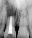 * These images were published in The Color Atlas of Endodontics, Dr. William T. Johnson, p. 176, Copyright Elsevier 2002.