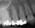 TOOTH FRACTURES Case One Fracture of the mesial marginal ridge of tooth #5,