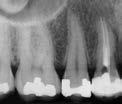 line) or fracture in enamel and dentin The fracture line does not extend apical to