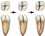enamel and dentin The fracture line may extend apical to the cemento-enamel