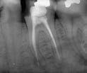 PROCEDURAL COMPLICATIONS Nonsurgical Root Canal Retreatment: Missed Canal Tooth #19 demonstrating