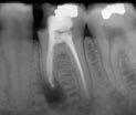 Recall TREATMENT CONSIDERATIONS/PROGNOSIS > Nonsurgical Root Canal Retreatment: Missed Canal The