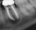 tooth #19 to correct apical transportation in the mesial root. 16 mo.