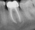 cal Root Canal Treatment: Altered Anatomy (e.g.