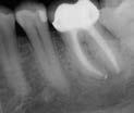 nonsurgical treatment, retreatment or apical surgery Canals debrided and obturated to the procedural