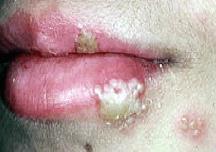 Genital Herpes Complications Genital herpes cannot be cured. It may cause cervical cancer in women.