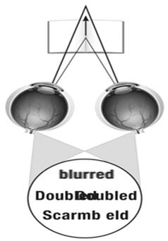 Vision Abnormalities 1. Vertical and Horizontal Gaze Stability 2.