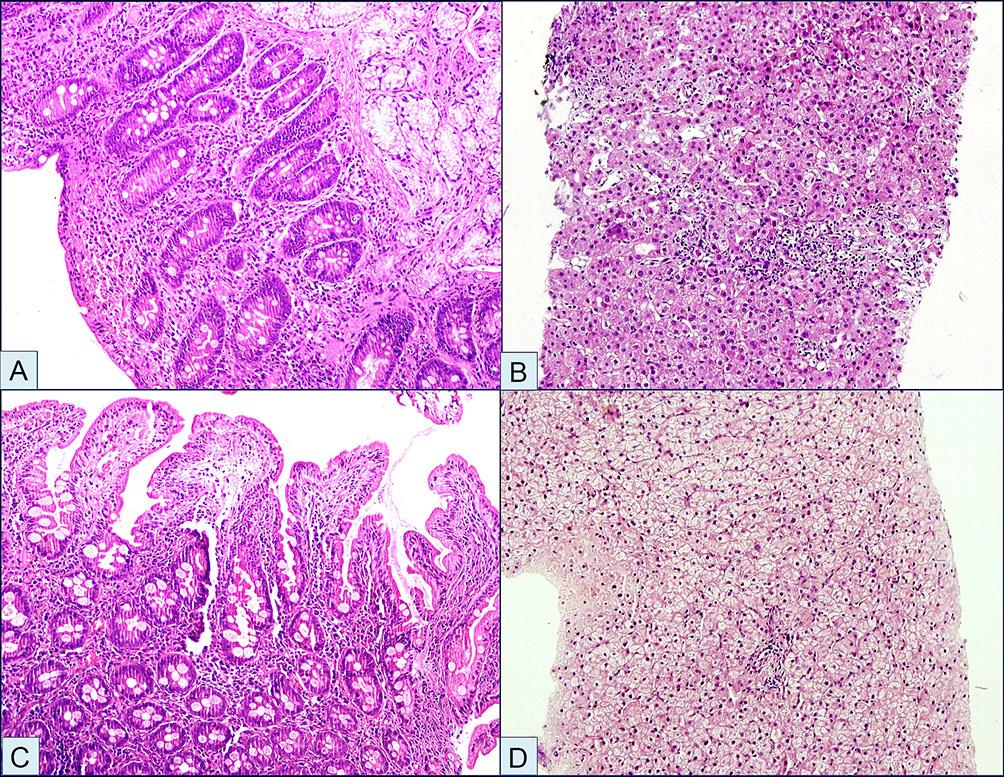 Downloaded from http://jcp.bmj.com/ on October 3, 2017 - Published by group.bmj.com Figure 3 (A) Pretreatment duodenal biopsy showing severe villous abnormality, increased intraepithelial lymphocytes (IELs) and crypt hyperplasia (Marsh 3C).