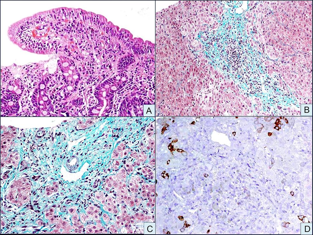 GFD were available in three cases initially diagnosed as CD, all of which showed histological improvement with reduction of fibrosis (figure 3).