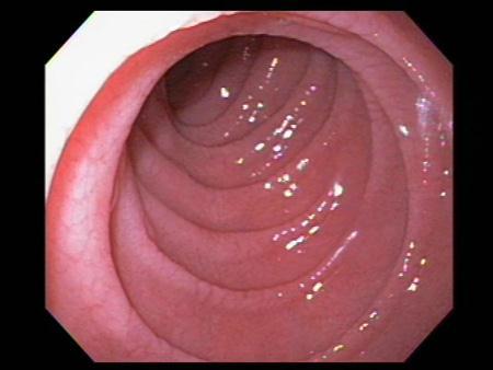 Duodenum (2) Loss of duodenal folds