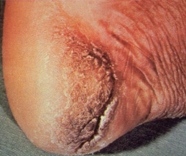 Foot Appearance Often Reveals Dry Cracked Skin or Fungal Infection Use a