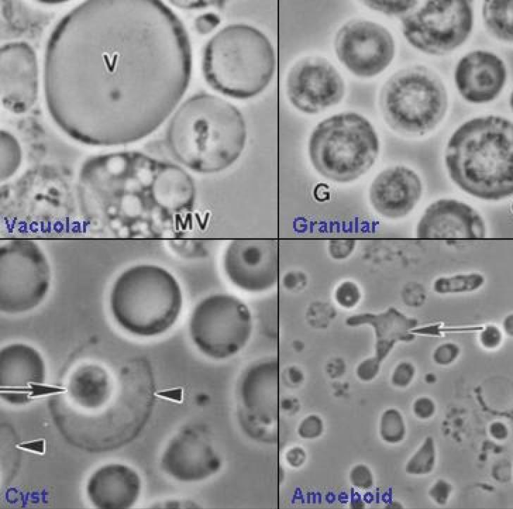 Protozoans Blastocystis hominis Blastocystis hominis Different subtypes (x13) Diarrhea, abdominal pain, nausea, vomiting, low-grade fever, gas, malaise, fatigue, chills,