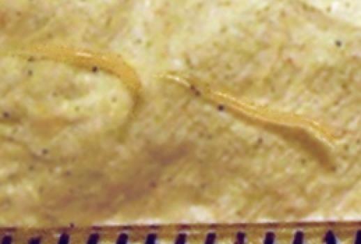 Worms - Pinworm Enterobius vermicularis Often asymptomatic Itchy anus, especially at night Very heavy burden may lead to