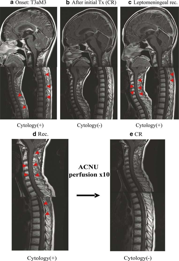 Fig. 2 MRI scans showing the effects of IT chemotherapy.