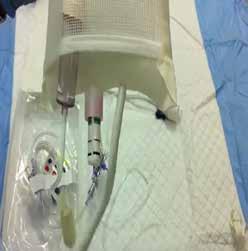Arterial Line Placement Spike NS Bag with transducer line