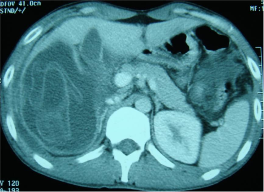 Besides the ruptured cyst, intact hepatic hydatid cysts were present in six patients and were definitively treated during the surgery.