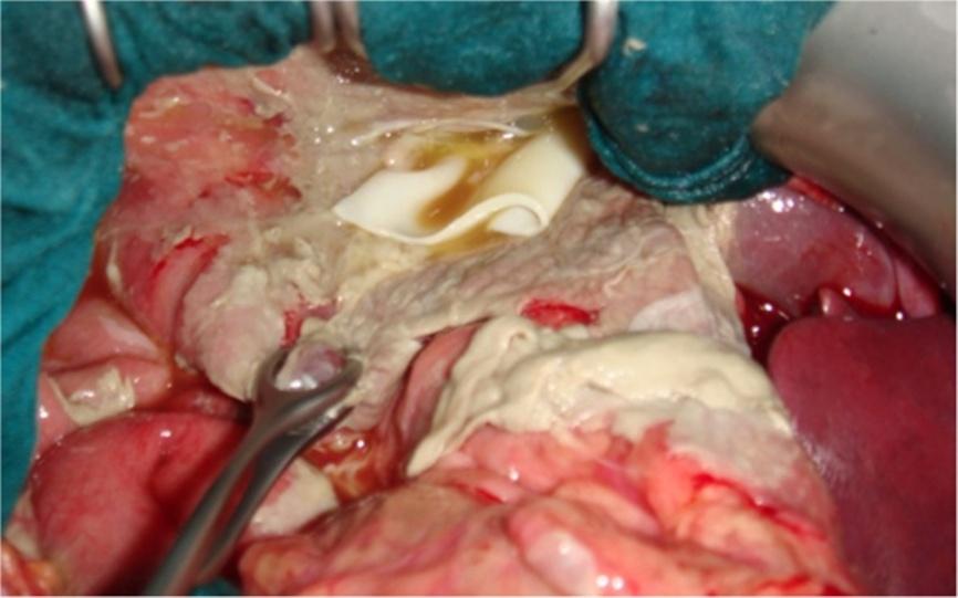 Mouaqit et al. World Journal of Emergency Surgery 2013, 8:28 Page 5 of 7 Figure 5 Intraoperative appearance of a cyst in the abdomen. intraperitoneal fluid.