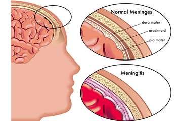 Infections Meningitis