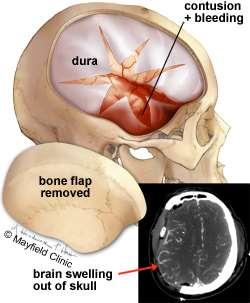Craniectomy Syndrome of the trephined Deficits that may improve with