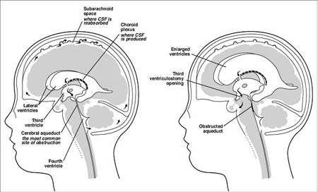 Hydrocephalus Non-communicating (obstructive) CSF flow is obstructed either between the ventricles or in exiting the