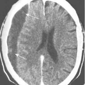 Subdural hematoma Change in mental status, signs of increased intracranial pressure