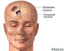 Seizures- risk factors Depressed skull fracture