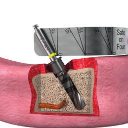 When placing angled implants, the cutter widens the distal bone to create space for placing the abutments later.