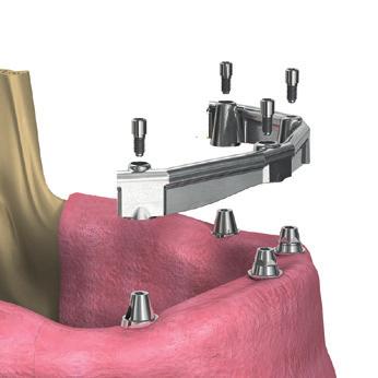 Following veneering and final finishing, the bridge is screwed into place passively from the occlusal aspect using the SIC Safe