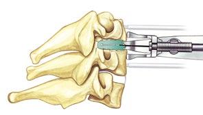 By the use of the depth stop, an optimal insertion depth of about 1-2mm inside the posterior (a) and of about 2-3mm inside the anterior border (b) of the original vertebral body contour can be
