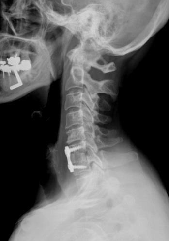 Cervical Fusion Eliminates Motion Patients have good neurologic results from ACDF and relief of
