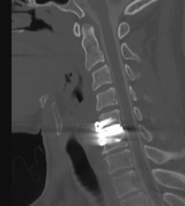 Post-operative Imaging Issues Devices fabricated with stainless steel or cobalt chrome.