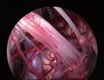 intraventricular endoscopy and/or endoscope-assisted skull base surgery