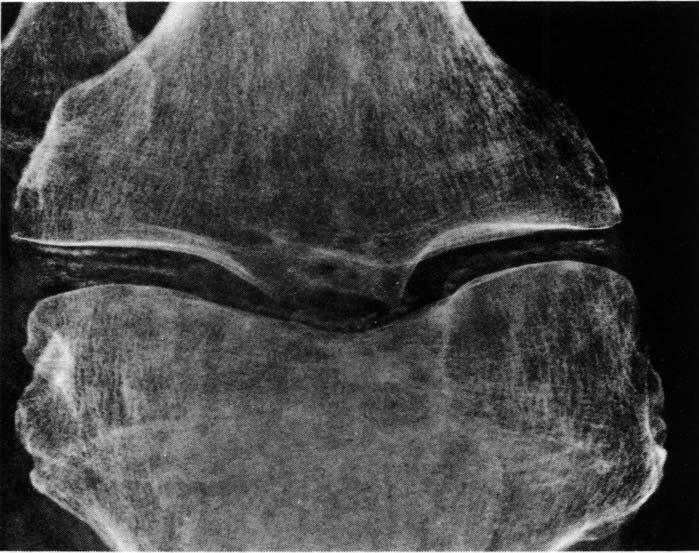 RADIOGRAPHIC FINDINGS Chondrocalcinosis Crowned Dens neck pain due to