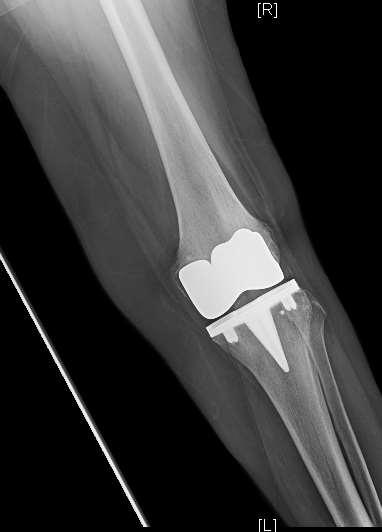 BALOG NOTE FOUR DIAGNOSIS: Left knee sprain, no evidence of