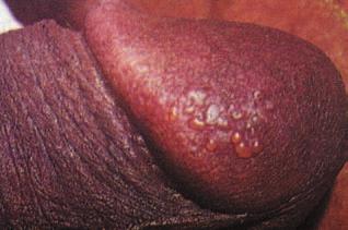occur every year in developing countries. The main STIs are classified by clinical syndromes a combination of symptoms a patient complains of, and signs identified during the clinical examination.