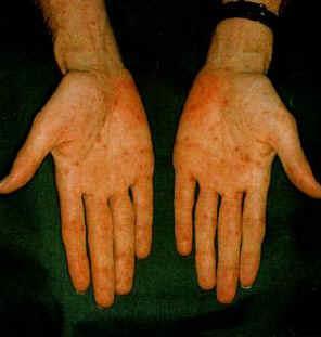 Syphilis Rash caused by Syphilis Type: Bacterial Occurrence: Over 150,000 new cases a year in the United States. Symptoms will occur 1-12 weeks after exposure.