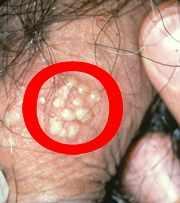 Genital Herpes A viral infection which can be caused by two different