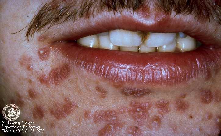 Syphilis This is an infection which is caused by a bacteria called Treponema pallidum. This infection occurs in three stages: 1.
