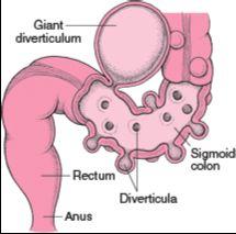 Pathophysiology of Diverticulosis Diverticulosis is the condition of having saclike herniations (Diverticula) on the colonic